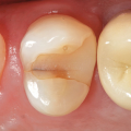 Причины возникновения зубной боли после депульпирования