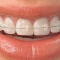 Как брекеты выравнивают зубы? Если нагрузка брекетов большая или маленькая?