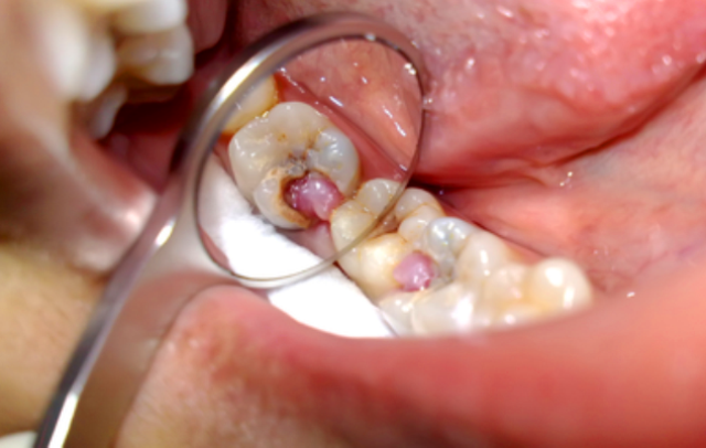 Больно ли лечить пульпит зуба? - фото 1