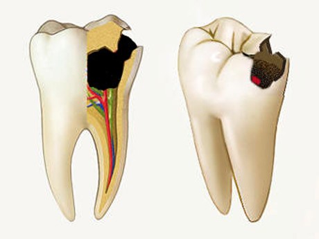 Заболевание зубов пульпит - фото 1