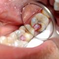 Пульпит зуба: симптомы