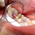 Больно ли лечить пульпит зуба?