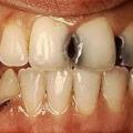 Кариес передних зубов