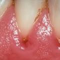 Вред зубного камня