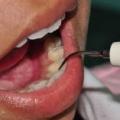 Лечение зубного камня