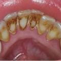 Причины зубного камня