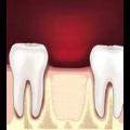 Причины возникновения боли в области удаленного зуба