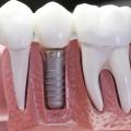 Протезирование и имплантация зубов. Плюсы и минусы.