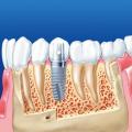 Установка зубных имплантов: технология совершенной улыбки