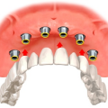 Протезирование или имплантация зубов: что выбрать?