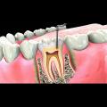 Виды протезирования зубов. Какой вид протезирования лучше?