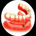 Протезирование нижних зубов: виды, применение, преимущества