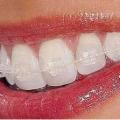 Эстетическая ортодонтия – прозрачные брекеты