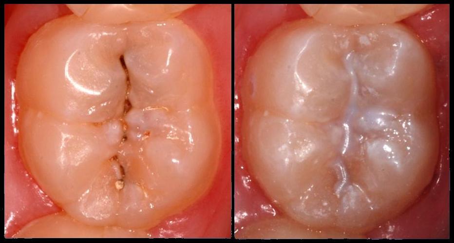 Так выглядит пораженный кариесом зуб до и после лечения