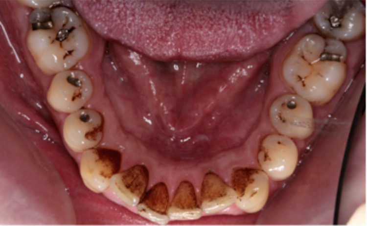 Курение способствует разрушению зубов: Рот курящего человека с кариесом.