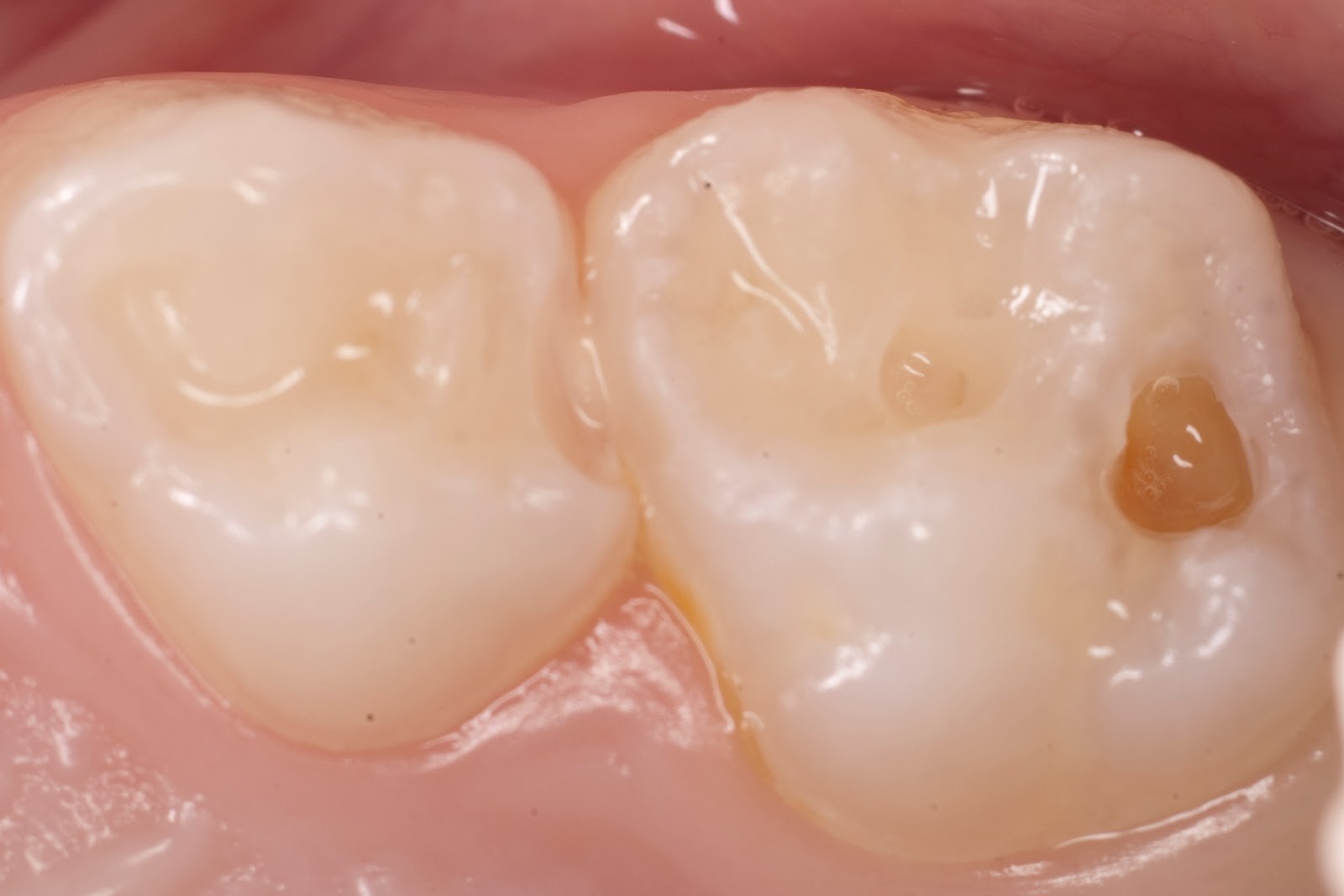 Средний кариес молочных зубов