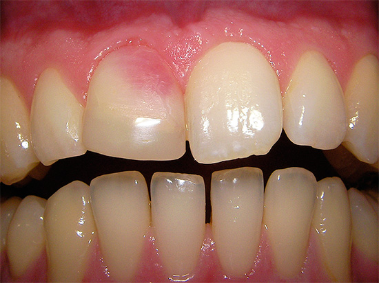 Кровоизлияние в пульпу зуба