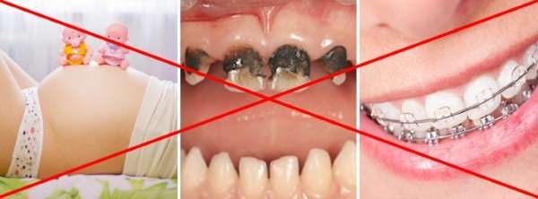 Противопоказания к внутриканальному отбеливанию зубов