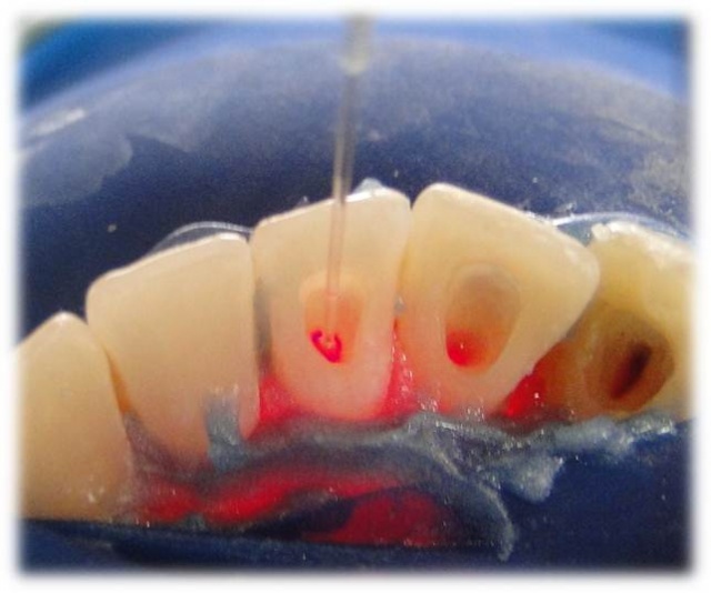 Процедура эндоотбеливания зубов