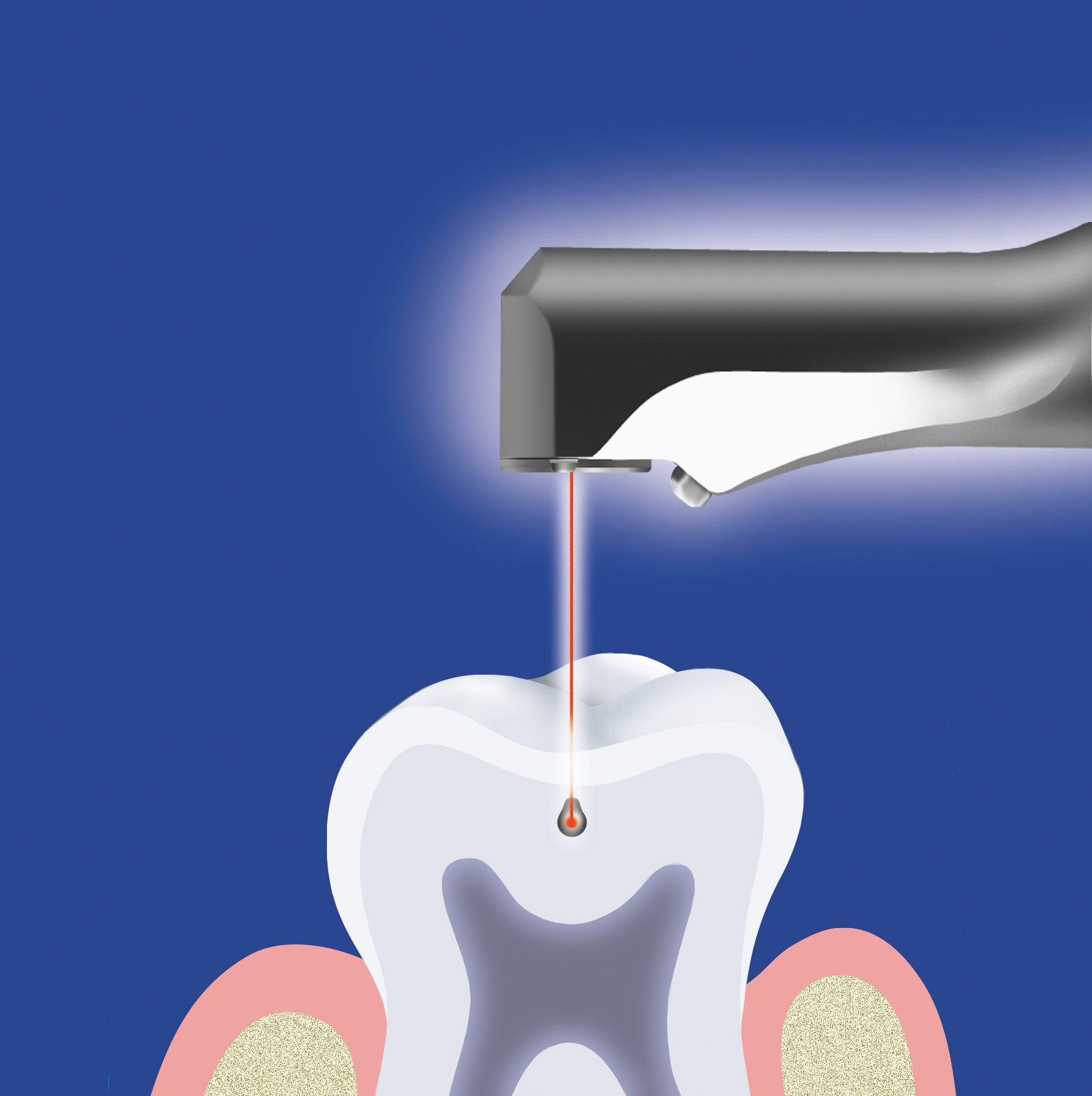 Процесс эндоотбеливания зубов