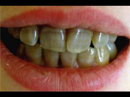 Внешние признаки потемнения зубов