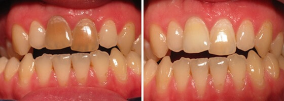 Зубы до и после эндоотбеливания