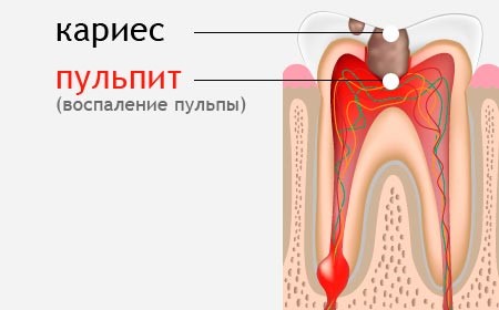 Больно ли лечить пульпит зуба? - фото 2