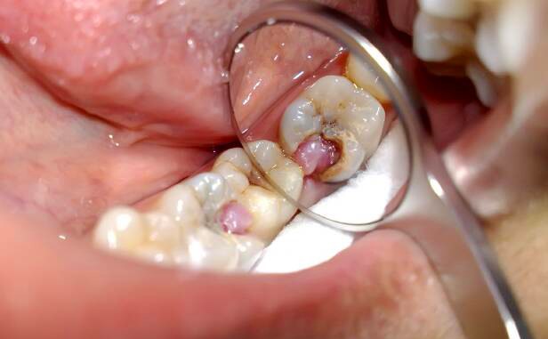 Пульпит зуба: симптомы - фото 1